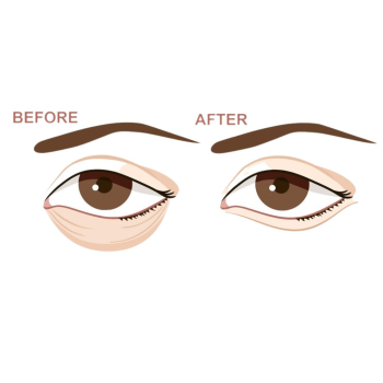 Antalya Health - Lower Blepharoplasty 