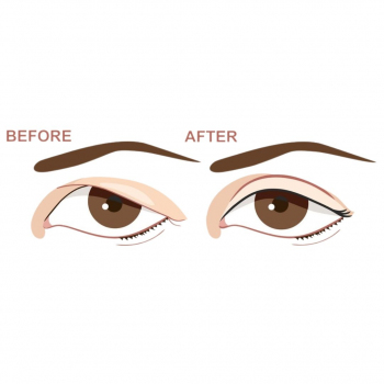 Colic Hospital - Upper Blepharoplasty 