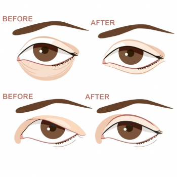 F Clinic - Upper or Lower Blepharoplasty 