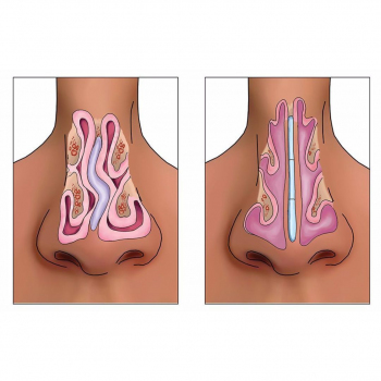 Metropolmed Clinic - Septoplasty 