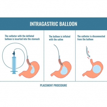 Metropolmed Clinic - Intragastrični balon 