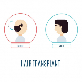 Estherian Clinic - Hair Transplant 