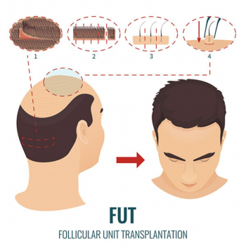 DRK Beauty Clinic - Hair Transplant: Follicular Unit Transplantation (FUT) 