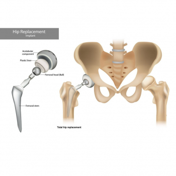 EsteBoss - Hip Replacement 