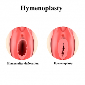 Cosmetocity - dr. Bora Yucel - Hymenoplasty 